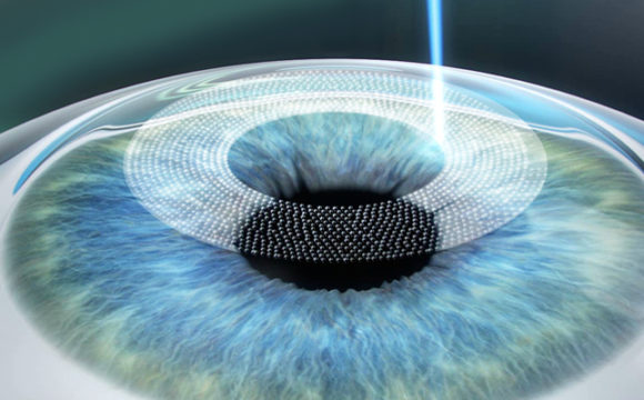 Chirurgie réfractive au laser PKR — M'Eye Clinic Nice
